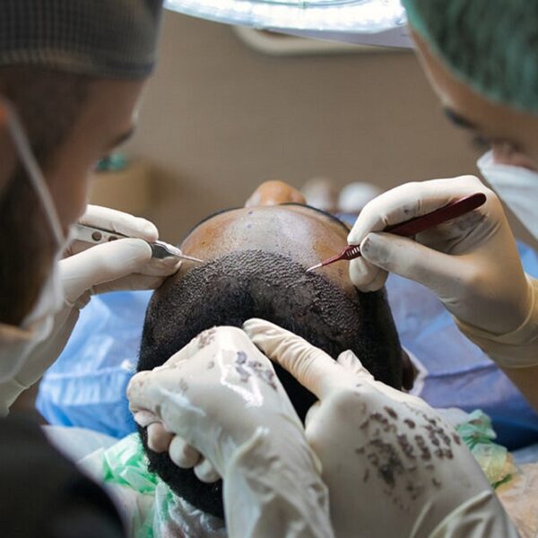 Unveiling the Science Behind Hair Transplantation